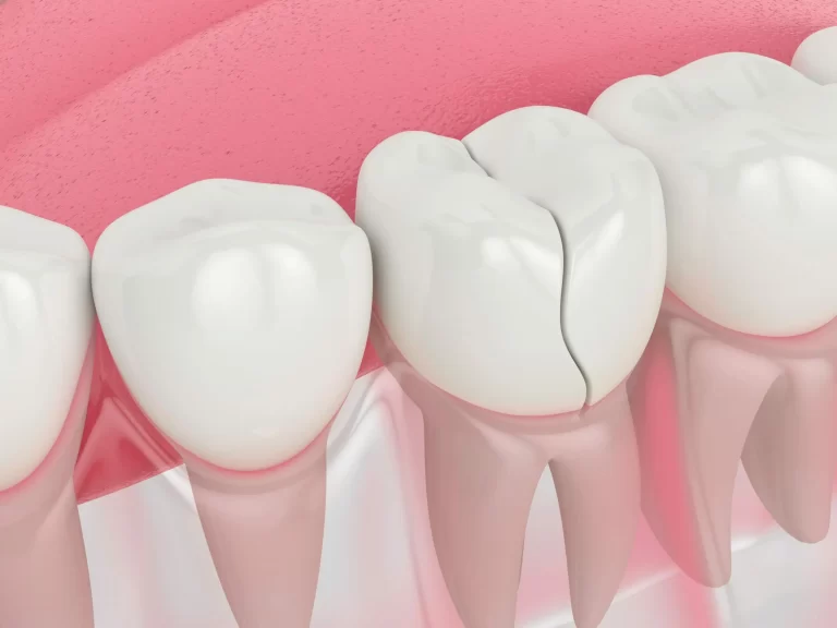 How to Fix a Chipped or Cracked Tooth?