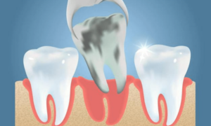What Is The Best Way To Recover After A Wisdom Tooth Extraction?