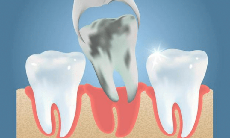 What Is The Best Way To Recover After A Wisdom Tooth Extraction?